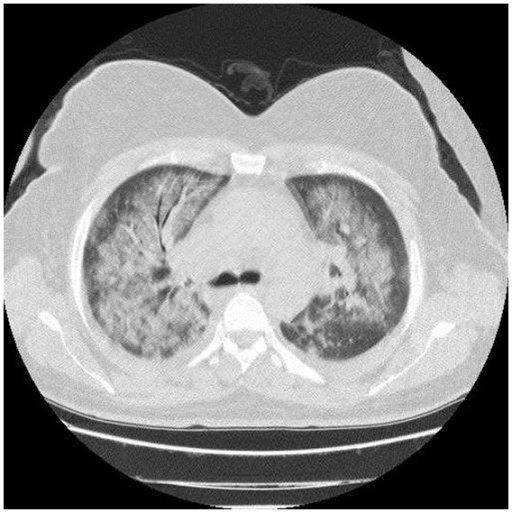 Example of a CT scan showing acute respiratory distress syndrome (ARDS